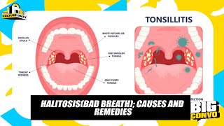 Halitosis Causes Effects And It’s Treatment [upl. by Renruojos617]