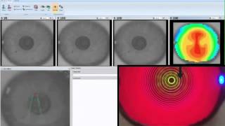 Corneal topography [upl. by Odlanyer]