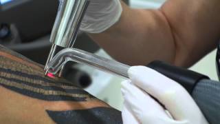 Laser Tattoo Removal  Lenzie Clinic [upl. by Anelim]