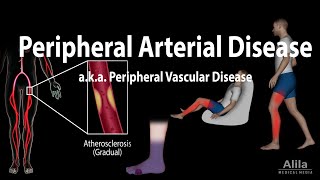 Peripheral artery disease Pathophysiology Causes Symptoms Diagnosis and Treatments Animation [upl. by Releyks]