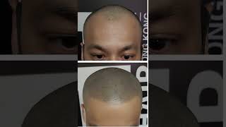 quotReclaim Confidence with Scalp Micropigmentation SMP  Hair Loss Solution for a Younger Lookquot [upl. by Jopa]