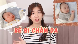 Henry Bị Chàm Sữa Và Chăm Sóc Da Cho Bé Khỏi Chàm Như Thế Nào [upl. by Atnamas254]