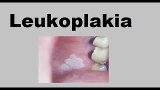 Leukoplakia [upl. by Nitsyrk]