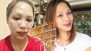 SEVERE CHICKENPOX IN ADULT SOBRANG MALALA  Misskhae [upl. by Acissj]