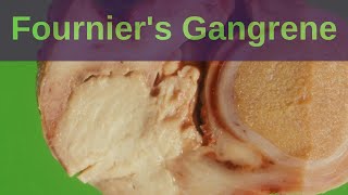 What is Fourniers Gangrene  Pathology mini tutorial [upl. by Seugram]