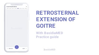 Retrosternal Extension of Goitre  Examination  BasidiaMED Practice [upl. by Eirrahs]