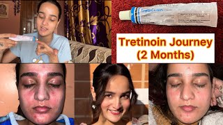 2 Month RetinolTretinoin Journey✨ [upl. by Nicky]