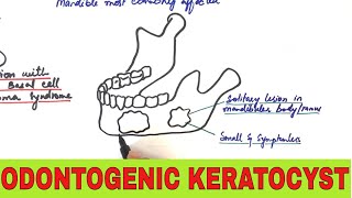 Odontogenic Keratocyst  Clinical Radiographic and Histopathologic Features [upl. by Chrissie]