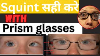 How to Correct SquintStrabismus With prism Glasses  Prism glasses Use [upl. by Karlens]