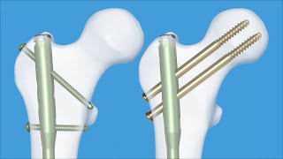 Femur  Fractures 32ABC 31B  Intramedullary Nailing Using the Expert Antegrade Femoral Nail A2FN [upl. by Eseeryt480]