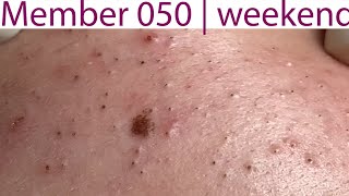 Acne Treatment Huong Da Nang 050  weekend  2023 [upl. by Urbannai]