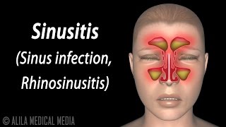 Sinusitis Animation [upl. by Seavey70]