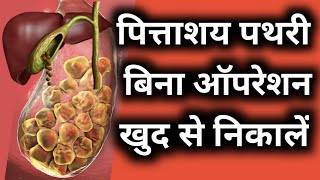 पित्ताशय Gall Bladder Stone खुद निकालें बिना ऑपरेशन के  Gall Bladder Stone Ka Ilaaj [upl. by Herc]