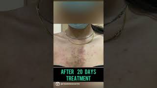 Best Back Acne Treatment in Punjab  Is Back Acne curable Dr Ashima Goel PARISA skin clinic [upl. by Lahcsap739]