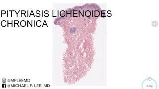 Pityriasis Lichenoides Chronica Dermpath Made Easy [upl. by Budworth]