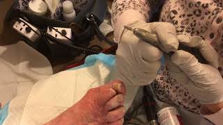 Foot Care Professional Uses Medicool ceramic bur to reduce thick fungal nails and calluses [upl. by Monreal]