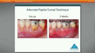 Improve your success with soft tissue grafting using acellular dermal matrix by Dr Edward P Allen [upl. by Asined]