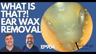 WHAT IS THAT EAR WAX REMOVAL  EP904 [upl. by Steven]