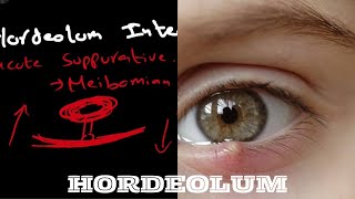 Hordeolum  hordeolum internum  hordeolum externumStye [upl. by Wollis]