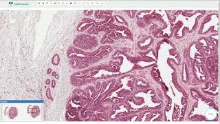 Hidradenoma Papilliferum  Histopathology [upl. by Eylhsa]