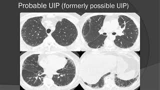 HRCT Imaging of Fibrotic Interstitial Lung Disease New Classification of UIP [upl. by Attekal]