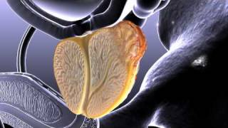 Prostate Cancer Animation [upl. by Esemaj394]