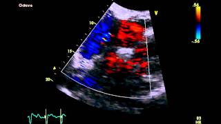 Patent Foramen Ovale  Transthoracic Echocardiogram TTE [upl. by Duke471]