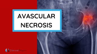 What is Avascular Necrosis AVN  Why does it happen Who gets it How do you diagnose it [upl. by Bergerac]