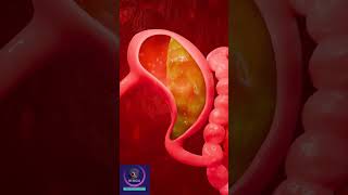 Gastroesophageal reflux disease  GERD Short Explanation [upl. by Flanagan431]