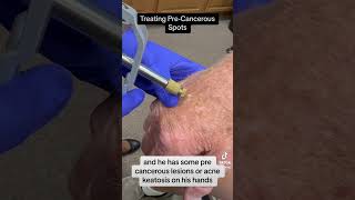 Actinic Keratosisprecancerous spot removal dermatology skin skincancer skincancerprevention [upl. by Omrellig]