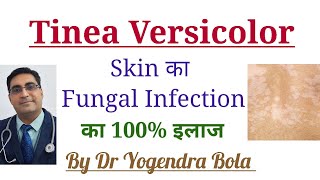 Tinea Versicolor Skin Infection ka 100 Treatment [upl. by Nowed]