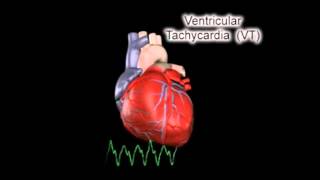 Ventricular Tachycardia VT [upl. by Artim880]