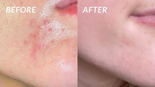 How I COMPLETELY got rid of my PERIORAL DERMATITIS in 4 DAYS the secret cure [upl. by Arther]