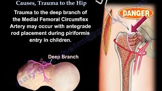 AVN Femoral Head Causes Trauma To The Hip  Everything You Need To Know  Dr Nabil Ebraheim [upl. by Lyn]