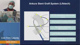 LINC 2017 Lifetech Ankura TEVAR live case with Dr Andrej Schmidt [upl. by Rask]