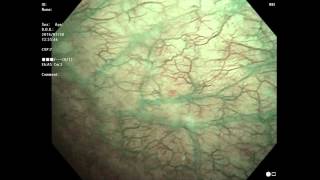 interstitial cystitis 間質性膀胱炎 6回目 膀胱鏡 [upl. by Latouche526]