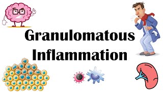 Granulomatous Inflammation  Types Pathophysiology Different Cell Types In Granuloma amp Examples [upl. by Ominorej]