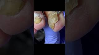 Broken onychomycosis with a layer of germs underneath【Doctor Liu Pedicure】 [upl. by Kerri]