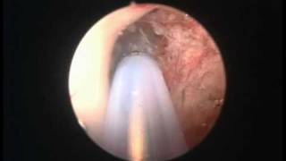 Colloid cyst endoscopy [upl. by Samara]