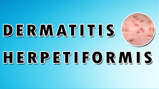 Dermatitis Herpetiformis Symptoms Treatment and Causes [upl. by Ermengarde]