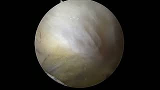 All Arthroscopic Management of Lateral Patellar Instability [upl. by Jollanta]