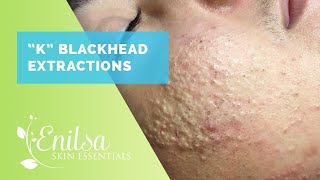 Blackhead Extrations on quotKquot  Hes back [upl. by Flavia]