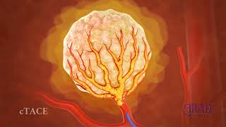 Liver Tumor Embolization amp Chemoembolization [upl. by Vanhook85]