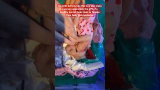 A fatal case of teratoma sad sick gratitude poor blessed Teratoma birthdefects reels cute [upl. by Nnylav]