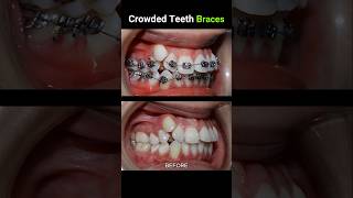 40 months for this braces Crowded teeth braces orthodontist dentist dentistry [upl. by Melvyn]