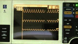 Ventricular Tachycardia [upl. by Aramen582]