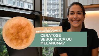 PÍLULA DERMATOSCÓPICA 60 CERATOSE SEBORREICA OU MELANOMA [upl. by Mackoff]