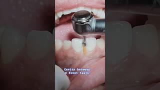 Cavities between front teeth viral smile fashion veneers youtubeshorts composite bondingasmr [upl. by Ynnol]