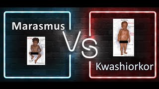 Pediatrics Difference between marasmus and Kwashiorkor PEM Protein energy malnutrition Age Growth [upl. by Camm]