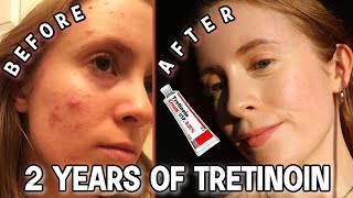 2 YEAR TRETINOIN UPDATE Before amp After Tretinoin Cream 005  My Current Skincare Routine [upl. by Koressa133]